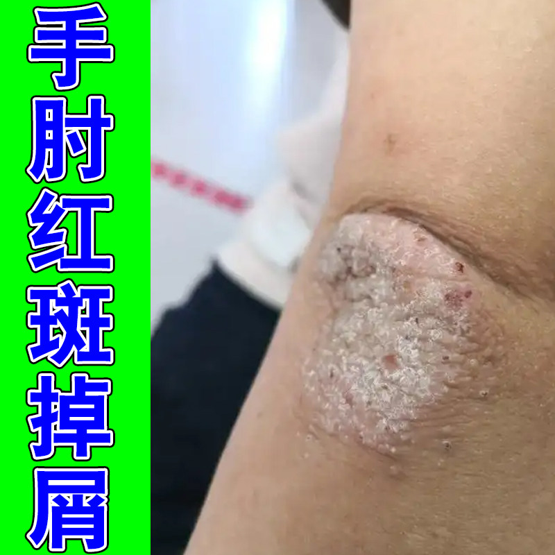 手肘红斑掉屑痒皮肤粗糙干燥神经性脖子后面痒起疙瘩长红点过敏痒