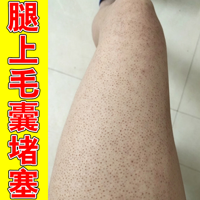 腿上毛囊堵塞毛孔粗大专用胳膊上长小颗粒小疙瘩皮肤粗糙干燥修护