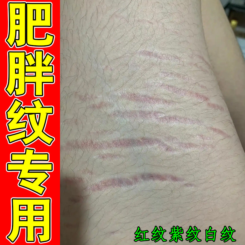 肥胖纹专用腿上生长纹横纹紫纹白纹条状消学生大腿腹部屁股白纹路