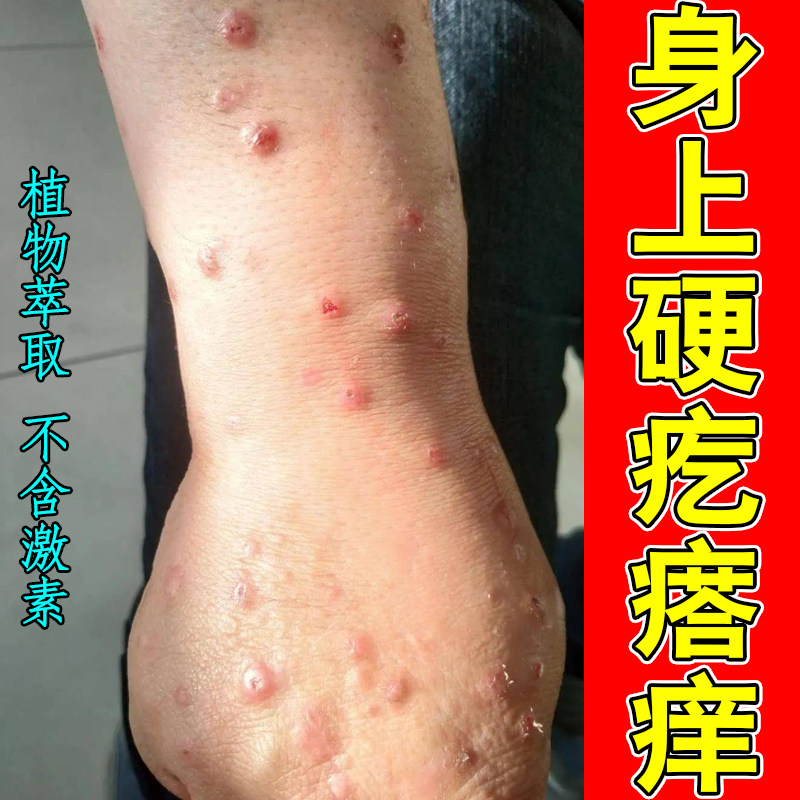 身上硬疙瘩痒皮肤干燥粗糙手臂上长硬块痘皮肤红斑痒的难受专用膏