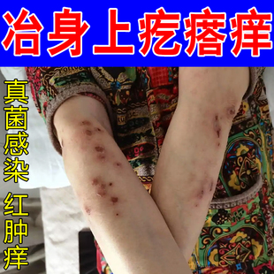 冶身上疙瘩痒皮肤起硬疙瘩红肿小腿皮肤痒顽固真菌痘痘红斑专用膏