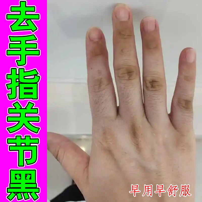 手指关节暗沉护理膏指节肤色不均手部老废角质指根发黑粗糙专用膏