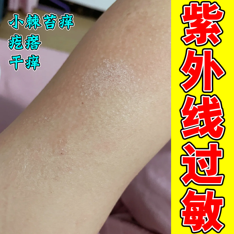 身上皮肤痒胳膊干燥粗糙痒起皮干红疙瘩专用修复药