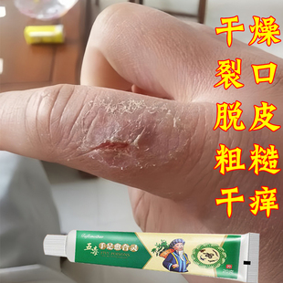 专冶手裂的药膏手裂开防干裂手指开裂脚裂脚后跟干裂手裂口子