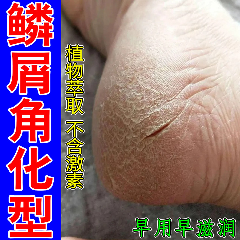 鳞屑角化型脚后跟干燥起皮裂口子干燥粗糙掉屑脱皮专用起硬皮草本