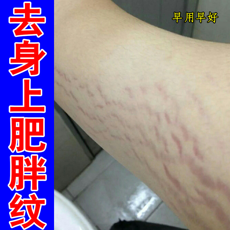 去身上肥胖纹腰腹上妊娠纹专用胳膊上长红色白色纹路粗糙淡化修护