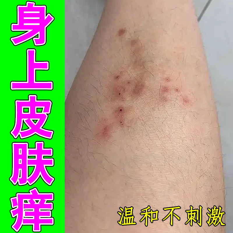 身上皮肤痒掉屑长硬疙瘩大腿内侧潮湿痒起红疙瘩红点脱皮蜕皮外用