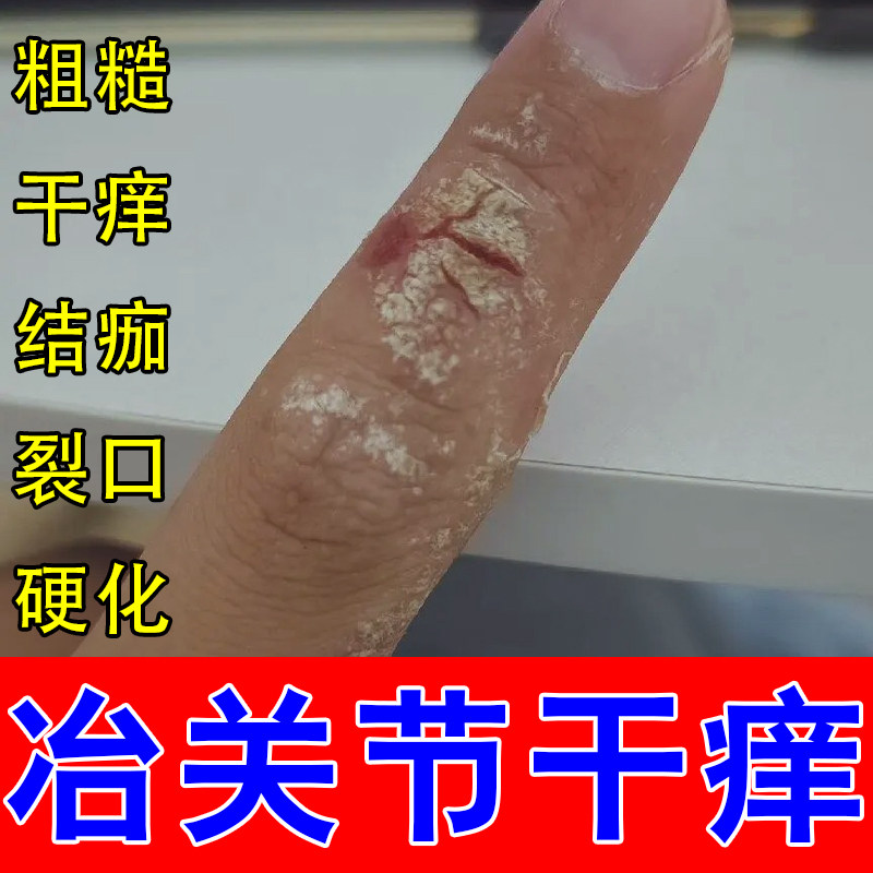 手指关节痒硬皮手指关节长硬疙瘩神经性手指开裂粗糙掉皮发痒软膏