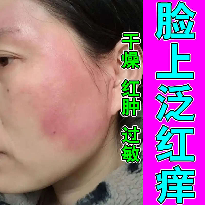 脸过敏发痒干燥脸部红痒过敏红肿皮肤消毒护理（消）