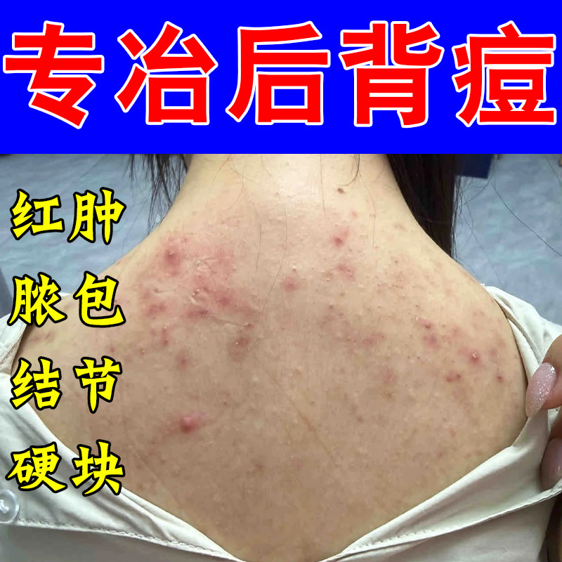 后背长痘身上后背红肿脓包疙瘩马拉色菌疙瘩红肿痒密集修护植物膏