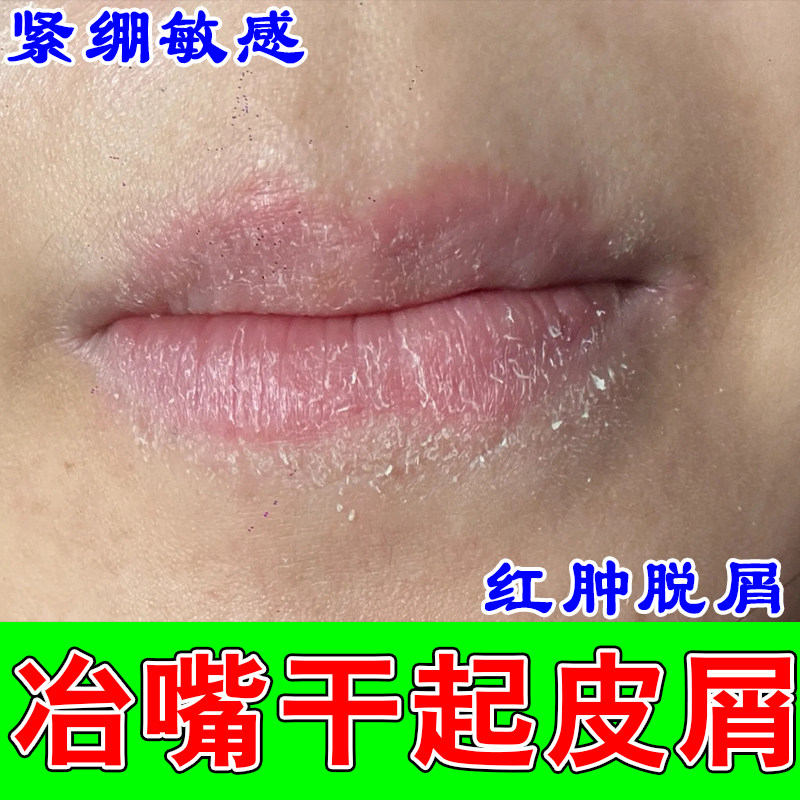 唇起皮紧绷起屑燥裂褪皮发灰燥裂唇皮起卷唇沟纹路润养锁水唇膏