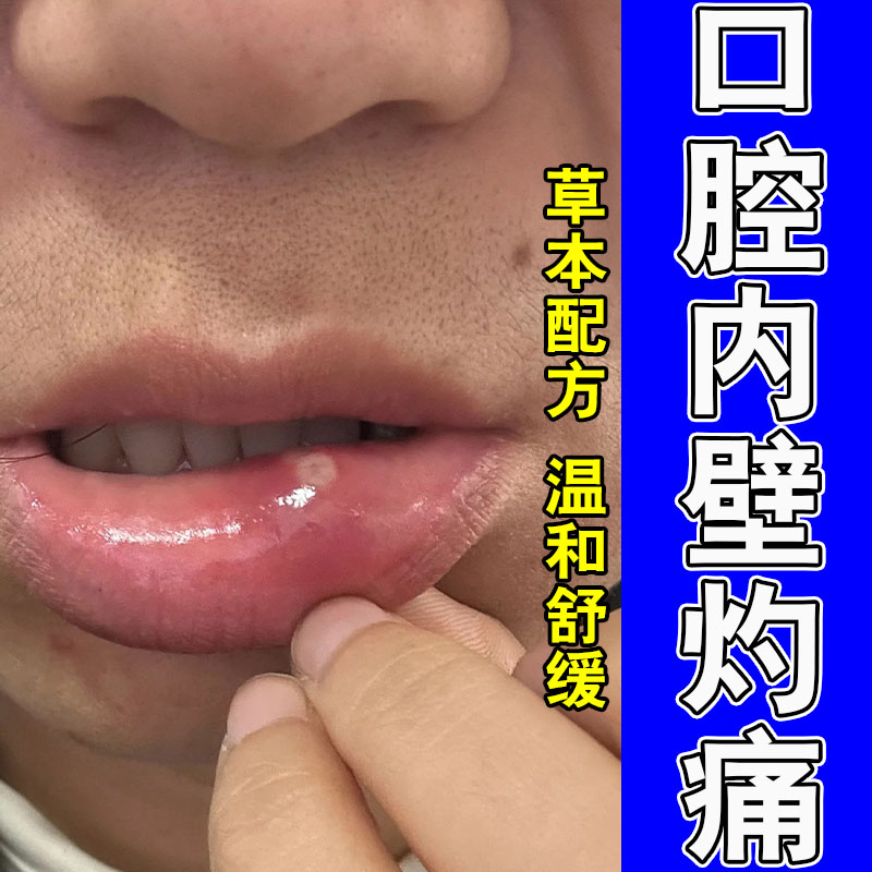 口腔长白斑舌头泛白起泡嘴巴上火口腔白斑疼痛草本修护喷剂