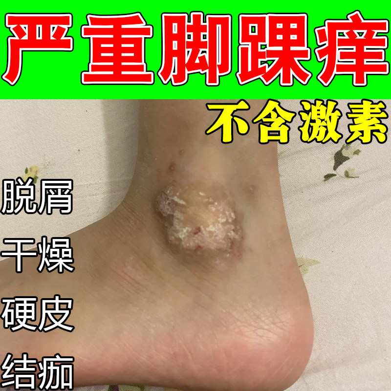 脚踝长红屑干痒斑点皮肤痒脚脖子腿部皮肤干燥发痒起皮掉皮外用膏