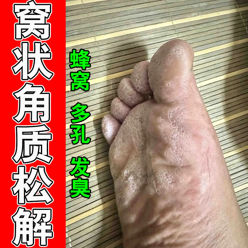 脚底板窝状角质松解脚底发白蜂窝状脚出汗脚臭草本修护膏