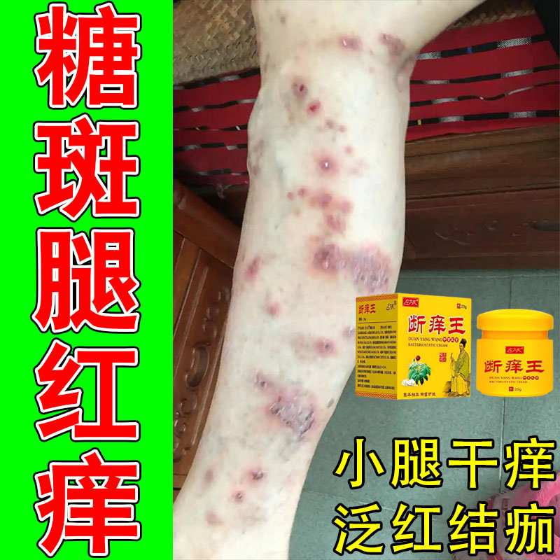 老年人小腿脚部肌肤干燥起疙瘩痒褐色大块糖斑肌肤痒疼植物修护膏