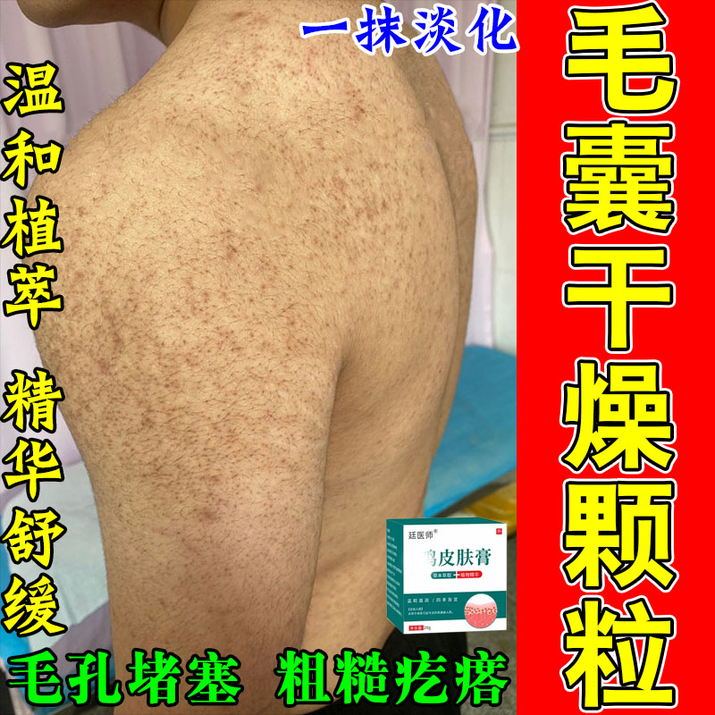 手臂鸡皮肤疙瘩毛囊角化去鸡皮肤角质胳膊上长痘深层清洁修复霜