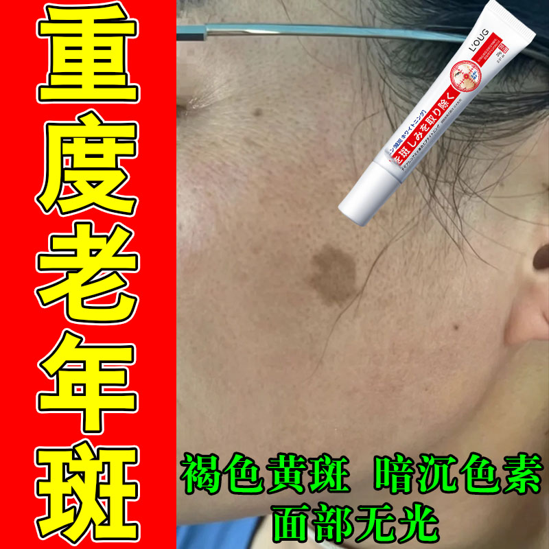 老年脸上斑强力脸部手部黑斑晒斑老人专用暗沉黄斑雀斑修护膏