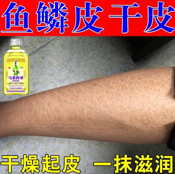 冶鱼鳞专用皮肤鱼鳞肤霜腿上干燥掉屑脱皮保湿补水甘油