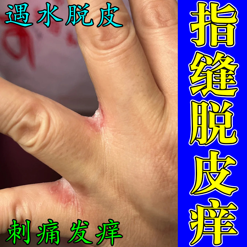 手指缝脱白皮渗水软膏手丫手指间经常碰水发痒开裂发红脱皮修护膏