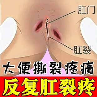 肛裂愈合膏陈旧性反复开撕裂疼痛大便带血肛周脓肿疼痛生肌膏