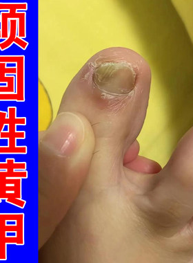 脚趾甲发黄脚趾甲变厚增厚变黄变硬真菌性白甲空甲修复草本软膏