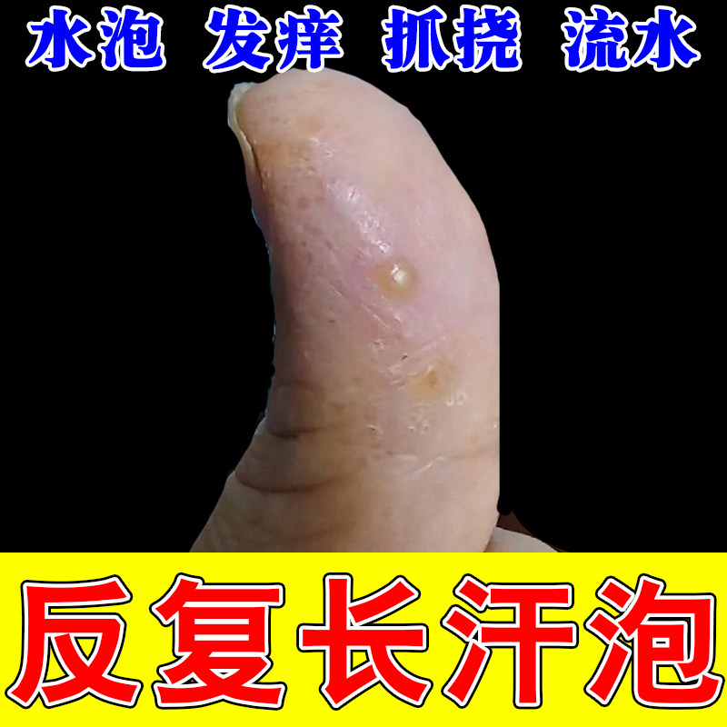 手指小水泡透明密集干痒粗糙透明颗粒疙瘩痒水泡痒干燥草本修护膏