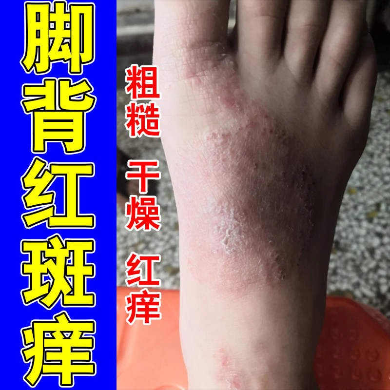 脚背痒起干皮红脚背疙瘩起皮痒真菌脚面红斑痒粗糙温和舒缓膏