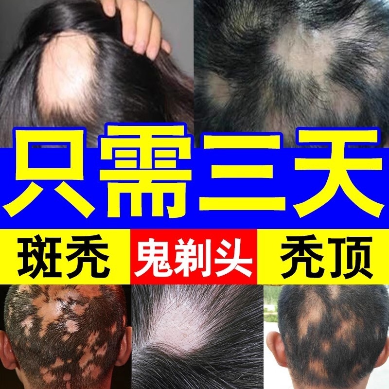 斑秃特效鬼剃头药防脱发严重专用洗发水一抹灵生姜生发液遮盖神器