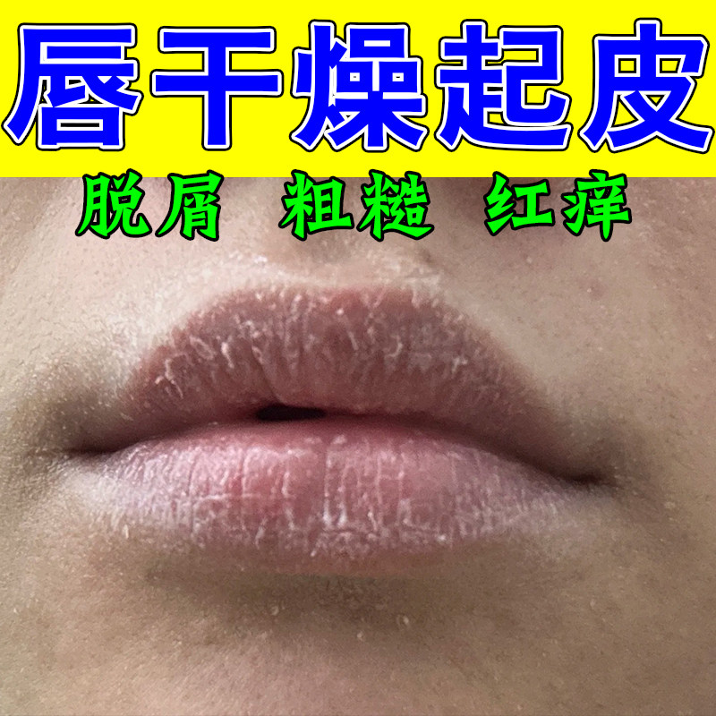 嘴唇干燥起皮干裂脱皮发白干裂嘴皮起皮唇纹明显保湿补水唇膏