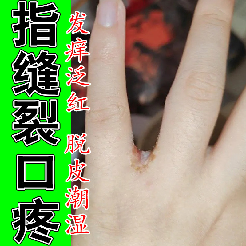 手指缝脱白皮渗水红痒膏药经常碰水手丫手气开裂疼脱皮水泡专用