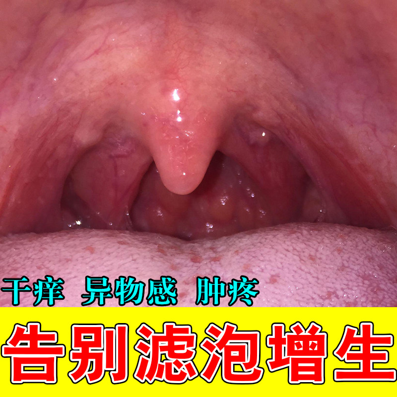 喉咙滤泡增生红肿疙瘩水泡淋巴滤泡舌根滤泡干痒有异物感喷剂
