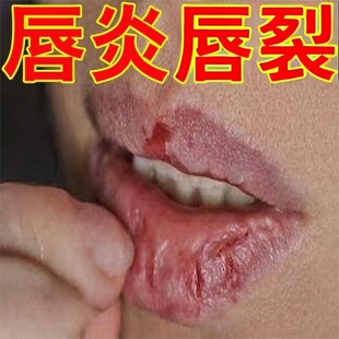 唇膏专用修护嘴唇干裂脱皮润唇膏嘴角嘴皮开裂结痂出血膏