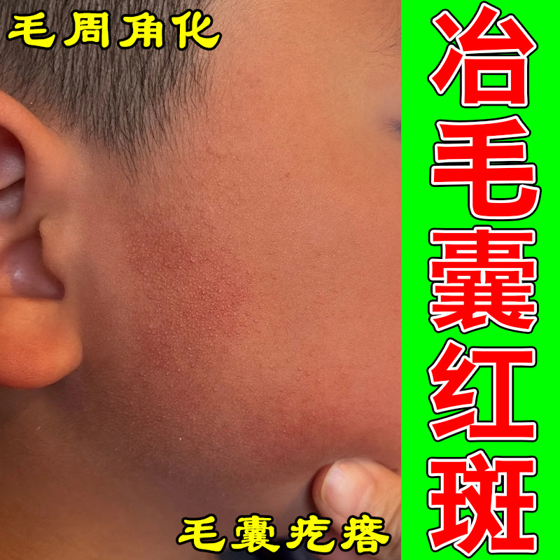 去脸上毛囊红斑黑变疙瘩脸颊两侧小颗粒颈部毛囊红斑黑变粉刺膏