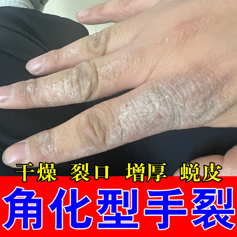 冶手背红斑大块脱屑手上长红斑起硬疙瘩干燥起皮真菌修护软膏