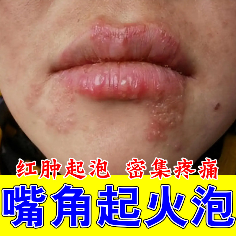 嘴唇泡嘴角上火起泡红肿痒嘴巴周上火干裂干燥脱皮小水泡疼专用膏