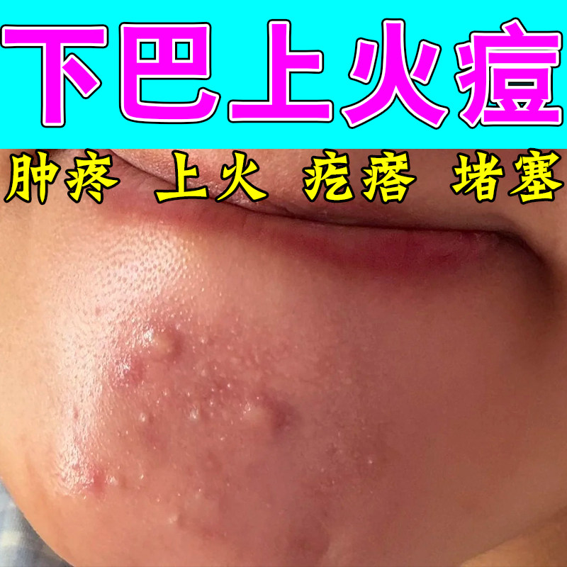 冶下巴痘闭口小疙瘩小颗粒脸部熬夜上火长痘粉刺外用保湿乳膏