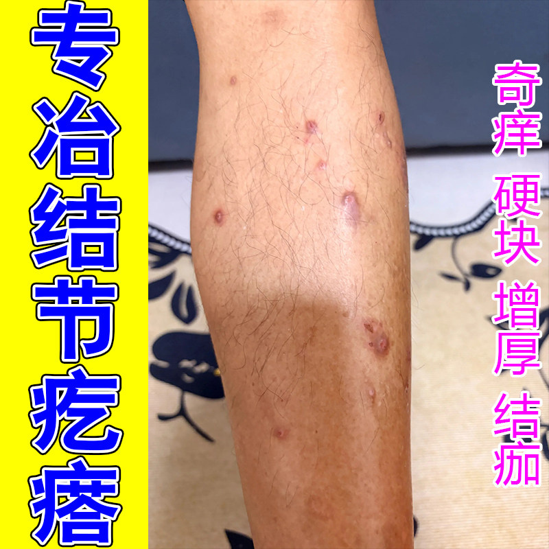 冶结节性痒疙瘩顽固红硬疙瘩皮肤虫咬疙瘩结痂痒红硬疙瘩膏
