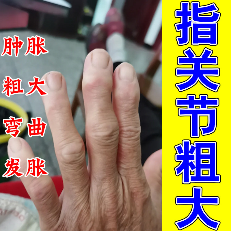 手指关节肿痛大专用修护骨膏老人晨起僵硬屈伸不畅草本修护软膏