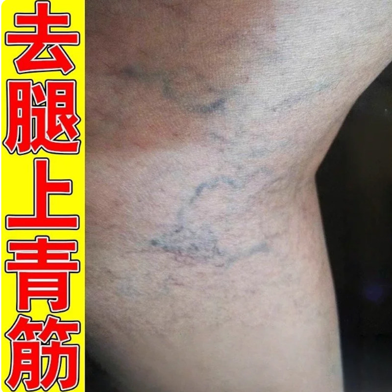 去腿上红血丝静脉曲张用专蚯蚓腿皮肤消毒护理（消）