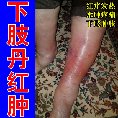 冶流火红肿下肢畏寒脚脖子疼痛肿胀灼热流火皮肤消肿草本膏