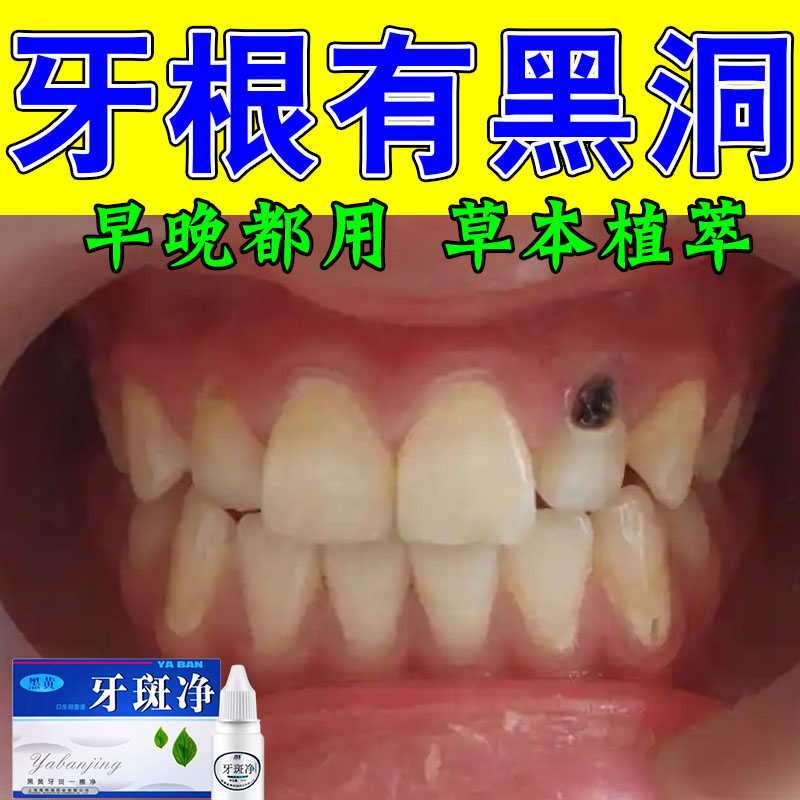 严重牙齿发黑牙黄有烟渍茶渍牙根发黑牙菌斑牙齿黄黑净牙液