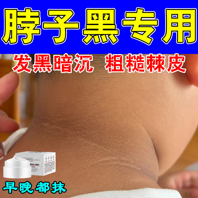 脖子黑色素去除黑棘皮脖子黑色素沉淀洗不干净暗沉黑色素按摩膏