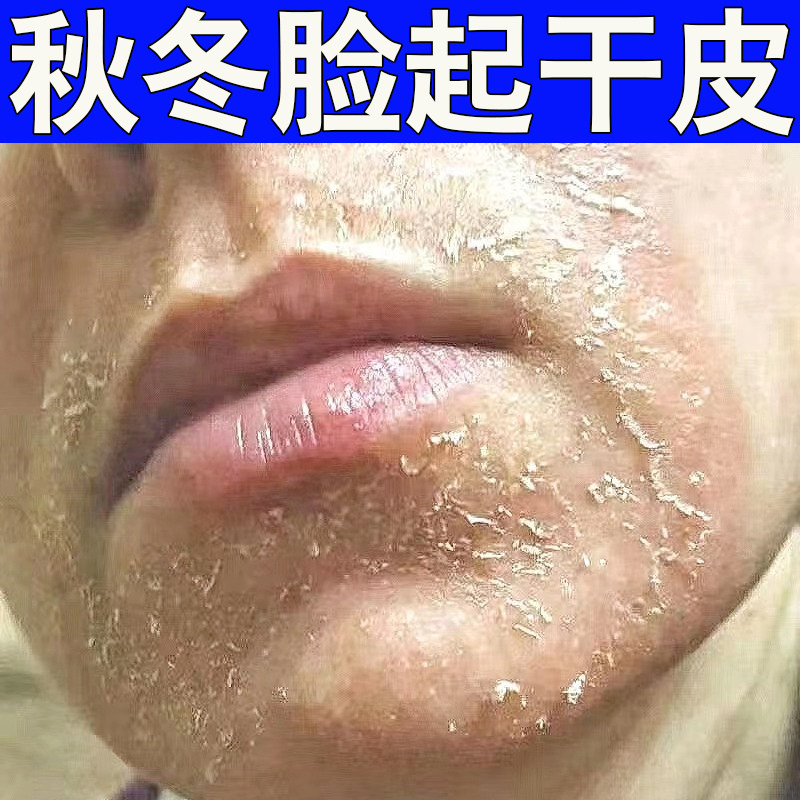 皮肤干燥起皮脸上脱皮红痒开裂保湿补水痒脸干男女爆皮修复