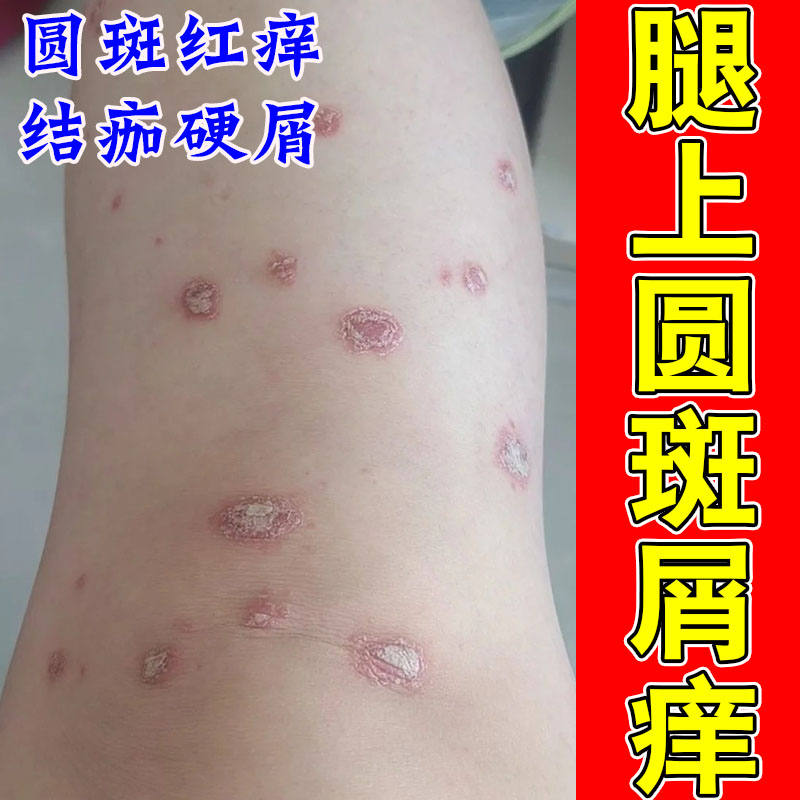 身上顽固白屑皮肤痒干燥粗糙起皮屑红肿痒草本修护软膏