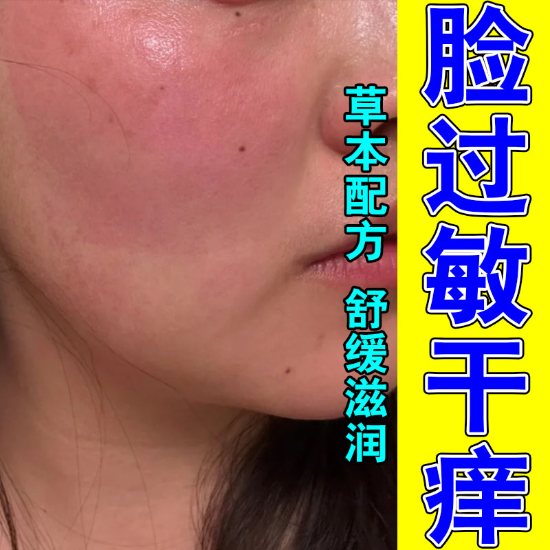 脸红脸过敏红脸敏感肌泛红红血丝遇热发红发热植物舒缓膏