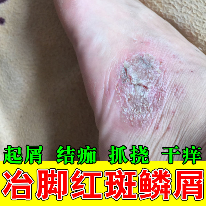 脚侧起屑角质粗糙痒脚侧面红点粗糙红疙瘩脚干燥脱屑植物萃取膏