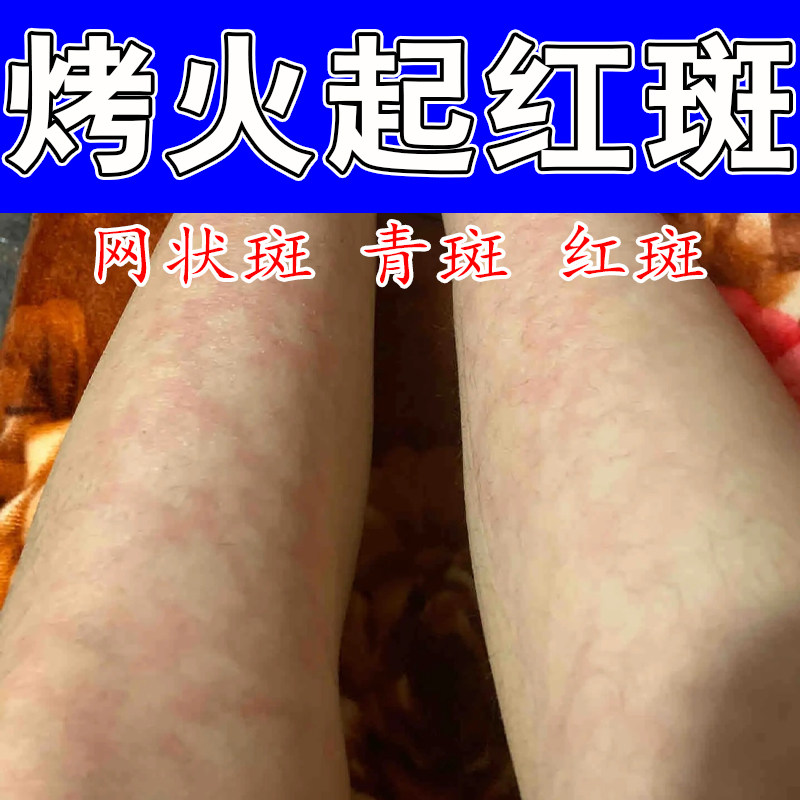 火激红斑高温低温烫伤烤火网状红班腿部长水泡毛细血管扩张修护膏