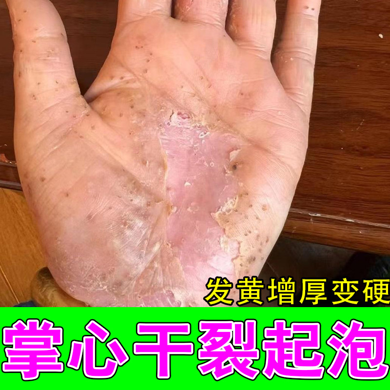 掌趾干裂跖角质化干杂粗糙手手红斑干裂蜕皮角皮掌跖干裂修护膏
