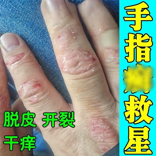 手指关节脱皮干裂真菌染起红斑鳞屑长硬疙瘩起干皮痒软膏
