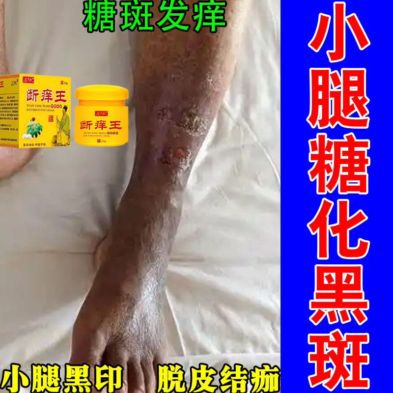 老人腿上褐色糖斑皮肤干痒疙瘩足部小腿肌肤粗糙干燥黑植物舒缓膏